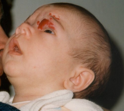 Veszélyes is lehet a tűzfolt, bőrelváltozás, dudor a kisbaba bőrén? Sebész szakorvost kérdeztünk