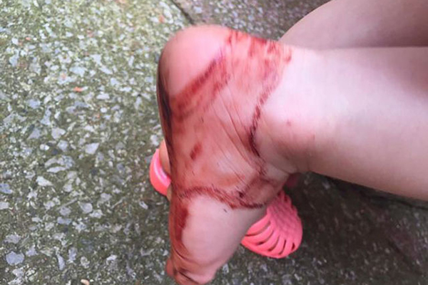 Ezért nem mindegy, milyen cipőt veszel a gyereknek! Nézd meg, milyen sérülést okozott egy műanyag szandál 