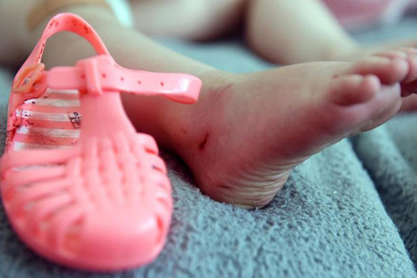 Ezért nem mindegy, milyen cipőt veszel a gyereknek! Nézd meg, milyen sérülést okozott egy műanyag szandál 