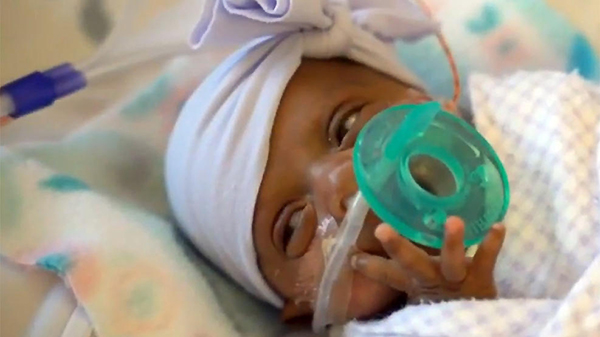 Hazaengedték a kórházból a világ legkisebb újszülött babáját! - 245 grammal született, nem hitték, hogy életben marad