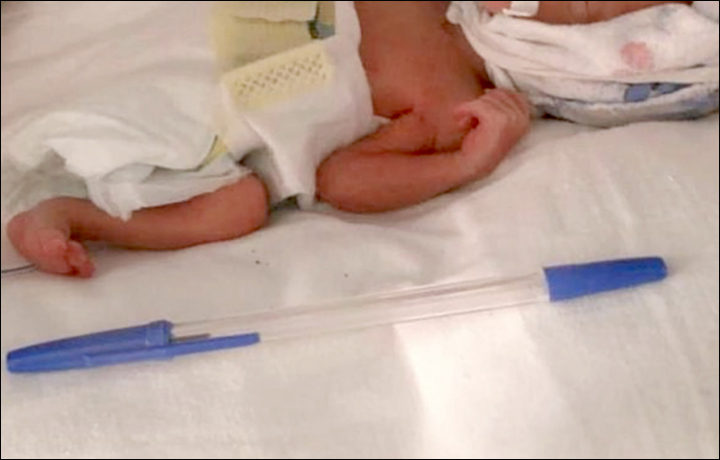 Csodát tettek az orvosok! Életben maradt a 23. hétre, 500 grammal született kisbaba - Csak akkora volt, mint egy golyóstoll