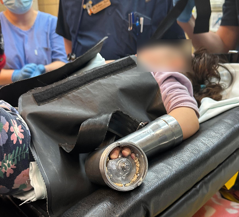 Húsdarálóba szorult egy kétéves kislány keze - Fotót is közzétett a Heim Pál Gyermekkórház